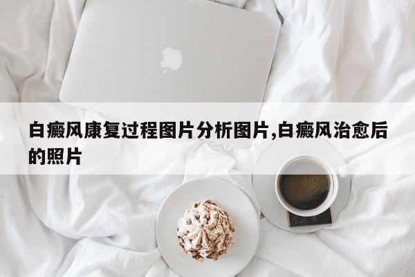 白癜风康复过程图片分析图片,白癜风治愈后的照片